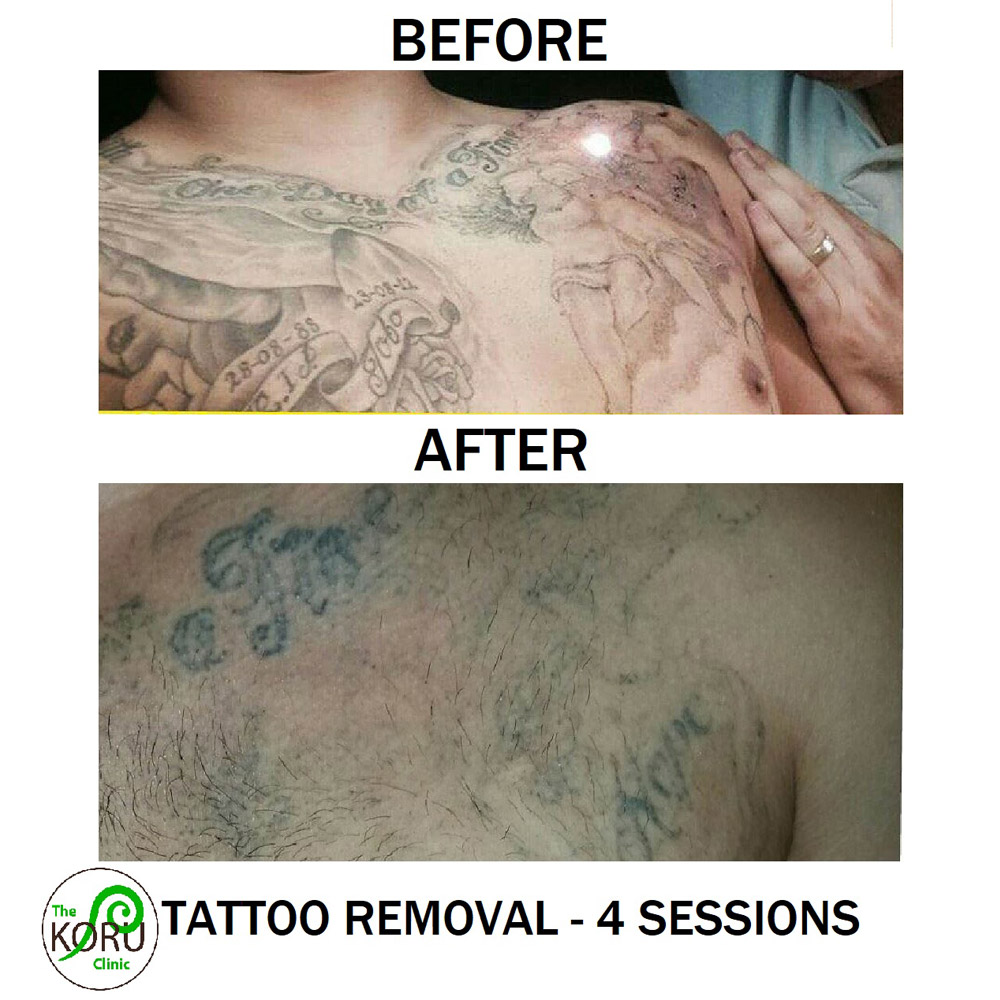 Tattoo by Koru Clinic